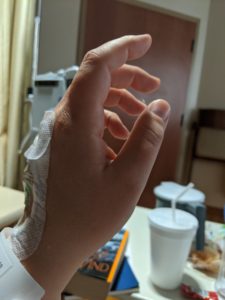 Hand with IV